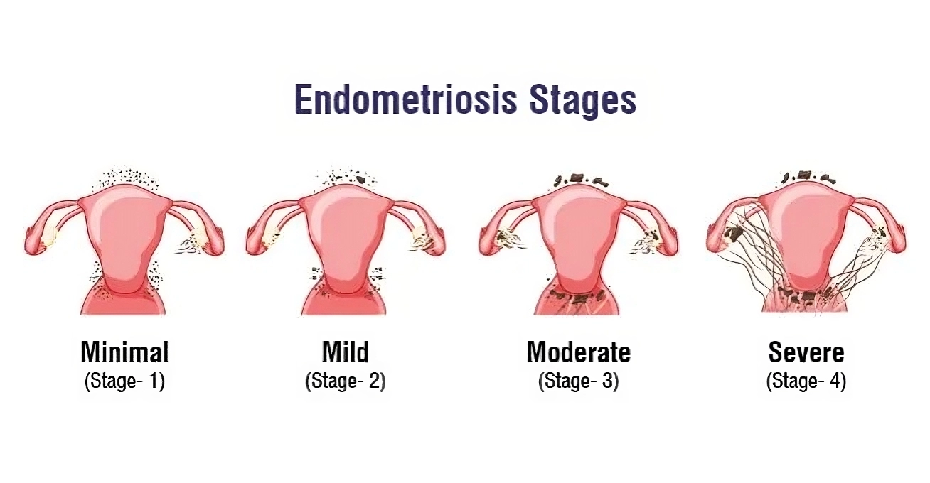 bladder endometriosis: