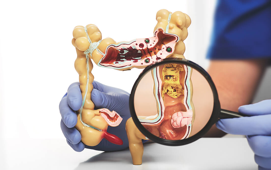 colorectal-surgery-chennai-and-coimbatore