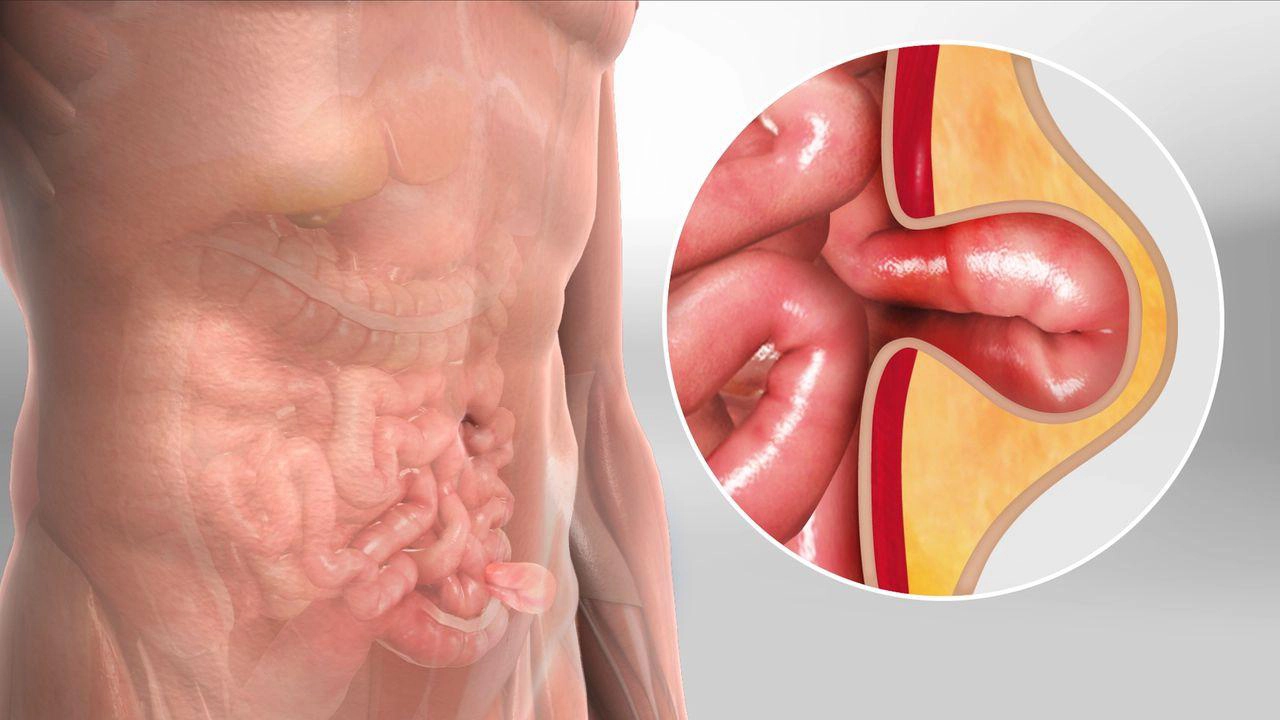 Hernia surgery treatment at GEM Hospitals Coimbatore and Chennai