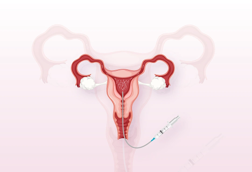 ivf
