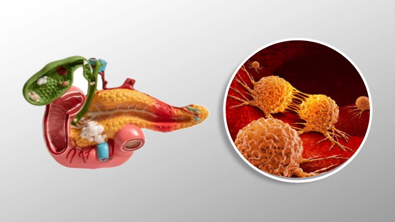 Pancreatic cancer diagnosis and treatment at GEM Hospitals
